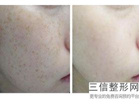 2022年上海拉皮除皱手术整形医院选择？上海沃德医疗中心盘点了公立私立优劣势并且价格也有