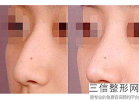 2022年上海冷冻法酒糟鼻治疗整形医院哪里有？上海百达丽医疗美容门诊部排名靠前