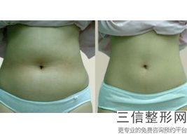 2022年上海冷冻溶脂瘦臀部整形美容医院排名！上海万众医院高居榜首