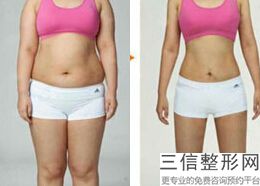 2022年上海冷冻溶脂瘦小腿整形医院哪里有？上海雍禾爱慕门诊望尘莫及