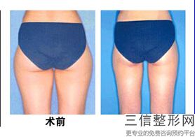 2022年上海冷冻溶脂瘦腰部整形美容院榜单！上海江依南医疗美容门诊部2022价格优惠情况！