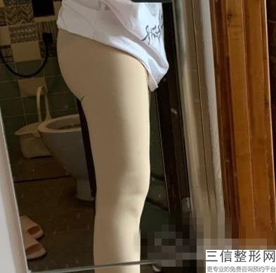 2022年上海冷冻溶脂瘦腰腹整形医院榜单！上海交通大学医学院附属仁济医院整形外科价格费用新出炉!.