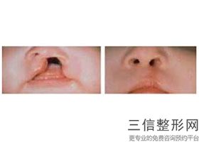 2022年上海裂唇修复整形医院三大排名!上海星采医疗美容门诊部公布3家当地有名气价格也实惠!