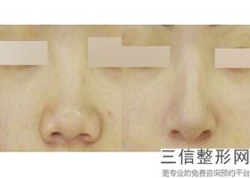2022年上海隆鼻修复整形医院哪家好?上海鸥美药妆医疗美容公立对比全国私立连锁