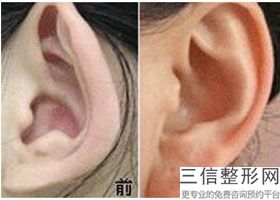 2022年上海隆耳垂美容整形医院排名！上海丽宣医疗美容公立对比全国私立连锁