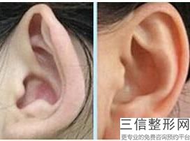 2022年上海隆耳垂整形美容医院排名！上海交通大学新华医院整形外科正规靠谱价格也不贵！