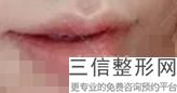 2022年上海伊维兰注射丰唇整形医院哪里有?上海佳富美医疗美容门诊部举世瞩目