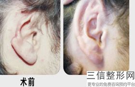 2022年上海隐耳矫正术整形医院选择？上海瑞金医院整形外科鹤立鸡群