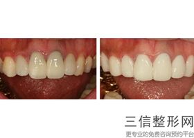 2022年上海隐形矫正牙齿整容医院前三名！上海医院都是私立机构入围_附价格费用参考