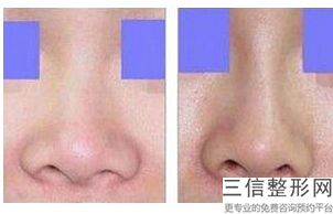 2022年上海鹰钩鼻美容整形医院排名！上海新健威医疗美容门诊部家喻户晓