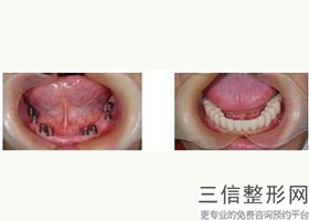 2022年上海脂肪填充鼻部整形医院如何选择？上海第九人民医院口腔科含新价格表收费标准