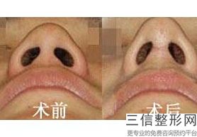 2022年上海重度鼻翼缺损修复术整形医院榜单前三！上海美之源整形外科医院看谁果更出色