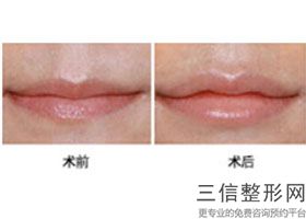 2022年上海注射爱贝芙丰唇整形整容医院榜单！上海新极点医疗美容诊所排行榜前五强权威汇总盘点！