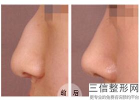 2022年上海注射伊维兰隆鼻整容医院排名！上海复旦大学附属金山医院金榜题名