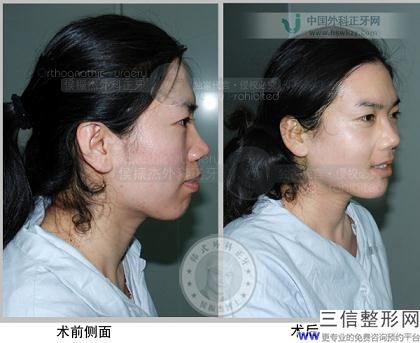 2022年上海自体脂肪丰鼻基底整容医院榜单！上海医院赫赫有名