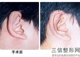 2022年上海自体脂肪丰耳垂术美容医院前三！上海美之源整形外科医院等大咖坐诊！价格优惠即可了解！