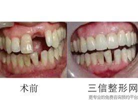 2022年天津矫正龅牙整形医院三大排名!天津艺姿蔓医疗美容医院医美公立私立汇总