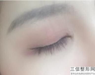 2022年天津开内眼角医院怎么选择？天津美莱医学美容医院2022价格优惠情况！