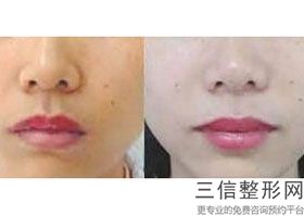 2022年天津拉皮除皱手术美容整形医院排名！天津美莱医学美容医院价格费用新出炉!.