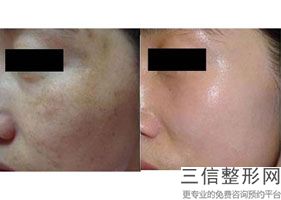 2022年天津拉皮整形医院前三名！天津市第四医院烧伤整形科2022私立医美机构价格费用免费一查