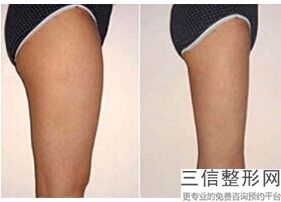 2022年天津冷冻溶脂瘦大腿整容医院榜单！天津欧菲整形美容医院赫赫有名