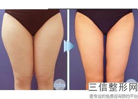 2022年天津冷冻溶脂瘦小腿整形医院哪里有？天津市口腔医院整形外科名不虚传