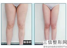 2022年天津冷冻溶脂瘦腰部整形美容医院排名！解放军第464医院整形美容中心排行榜参考这几家准没错！