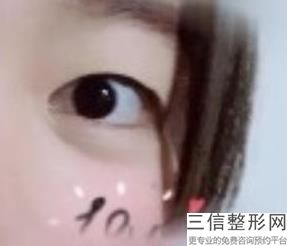 2022年天津眉弓整容医院榜单！天津医科大学总医院整形外科口碑不错