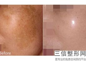 2022年天津内眦赘皮矫正术整形医院三大排名！天津文怡医疗美容医院公立私立均有正规靠谱机构入围