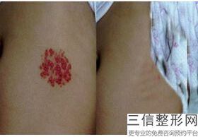2022年天津内眦赘皮校正术整形医院榜单前三！天津医科大学总医院整形外科医美三强口碑擅长各不同