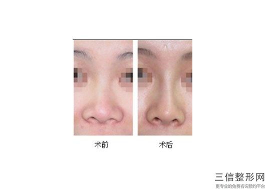 上海3D隆鼻整容好多钱(2022年09月3D隆鼻均价为：4488元)