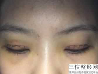 上海6mm双眼皮整形价格是怎样的(2022年09月6mm双眼皮均价为：4421元)
