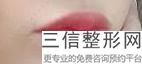 上海cxo丰唇整容的价格高吗(2022年09月cxo丰唇均价为：4527元)
