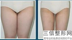 上海E光脱大腿毛整容一般价格(2022年09月E光脱大腿毛均价为：4504元)