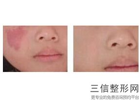 上海prp自体血清微针美容现在价格(2022年09月prp自体血清微针均价为：4569元)