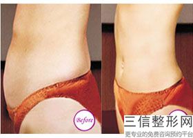 上海botox瘦手臂美容的费用贵吗(2022年09月botox瘦手臂均价为：4559元)