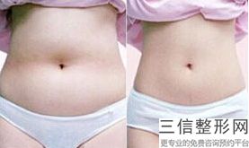 上海botox瘦小腿整容价钱贵不贵(2022年09月botox瘦小腿均价为：4497元)
