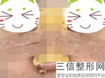 上海爱贝芙垫鼻整容价格范围是多少(2022年09月爱贝芙垫鼻均价为：4673元)