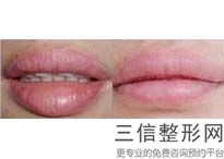 上海爱笑唇整形美容一般价格参考(2022年09月爱笑唇整形均价为：4413元)