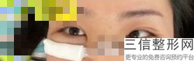 上海八毫米双眼皮美容具体费用范围(2022年09月八毫米双眼皮均价为：4529元)