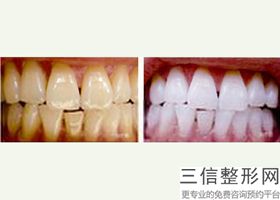 上海拔牙正畸美容价格是多少钱(2022年09月拔牙正畸均价为：4584元)
