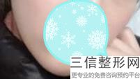上海薄唇变厚整容用多少钱(2022年09月薄唇变厚均价为：4390元)