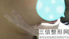 上海薄唇矫正整形多少费用呢(2022年09月薄唇矫正均价为：4432元)