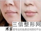 上海薄唇手术美容一般价位(2022年09月薄唇手术均价为:4462元)