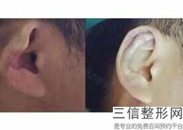 上海杯状耳修复美容价格是什么(2022年09月杯状耳修复均价为：4658元)