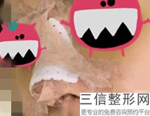 上海鼻背宽整容的价格要多少(2022年09月鼻背宽均价为：4581元)
