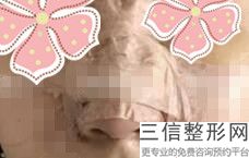 上海鼻背纹美容费用是多少钱(2022年09月鼻背纹均价为：4665元)