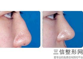上海鼻部修复美容平均费用(2022年09月鼻部修复均价为:4306元)