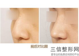 上海鼻部修复整形整容贵不贵(2022年09月鼻部修复整形均价为：4519元)