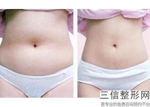 上海抽脂丰胸整容都是要多少钱(2022年09月抽脂丰胸均价为：4649元)